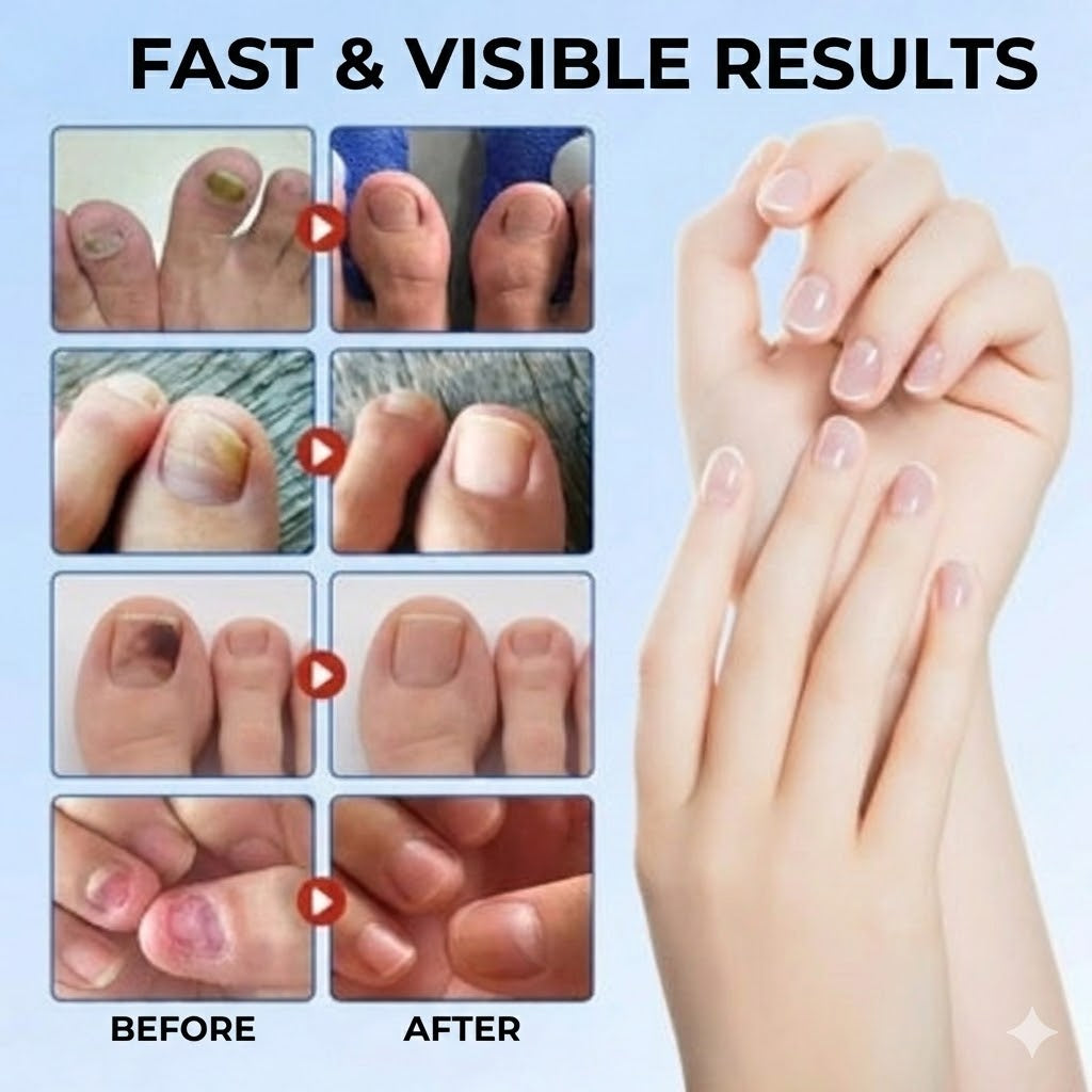 FungalPatch – Intensive Nail Care Set – Self-Adhesive Anti-Fungal Patches